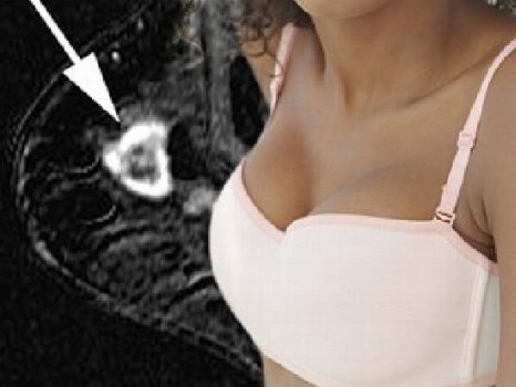 breast_cancer workshop